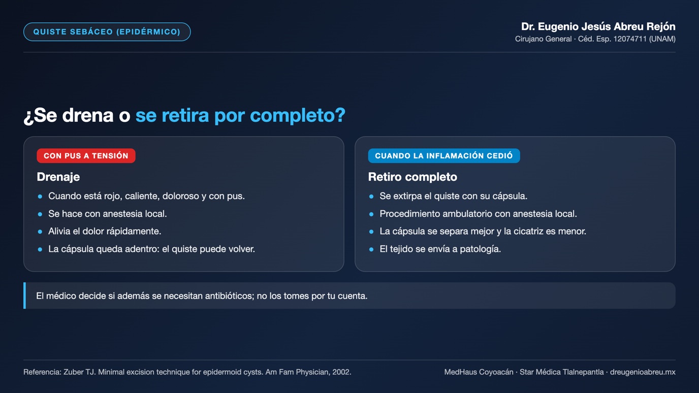 Lámina: cuándo se drena un quiste sebáceo y cuándo se retira por completo con su cápsula