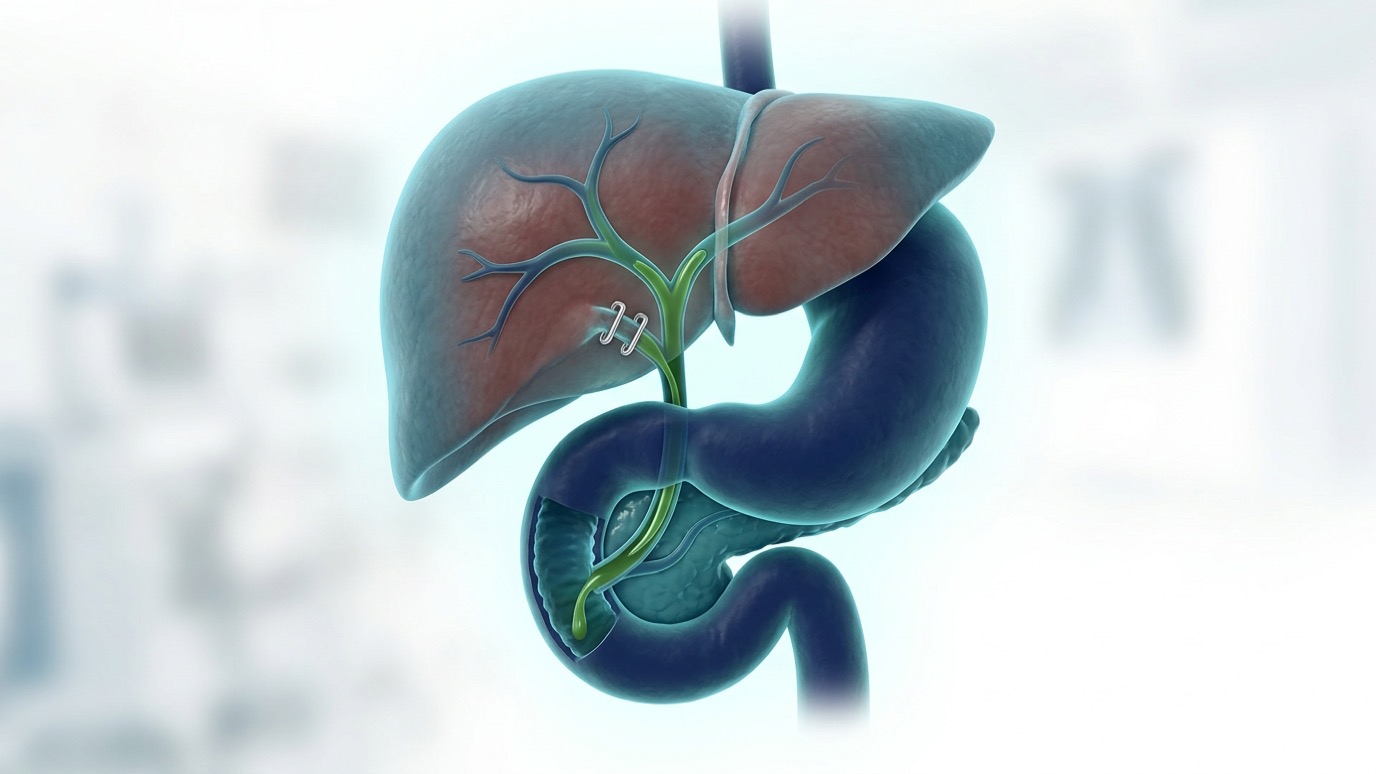 Ilustración del hígado y la vía biliar después de retirar la vesícula, con la bilis pasando al intestino